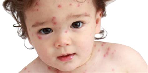 Hermina Hospitals | RECOGNIZE CHILDHOOD POX