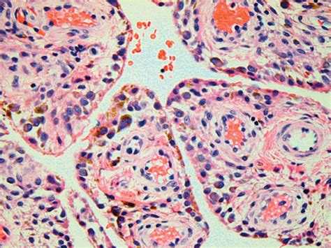 Pigmented Villonodular Synovitis - Pathology - Orthobullets