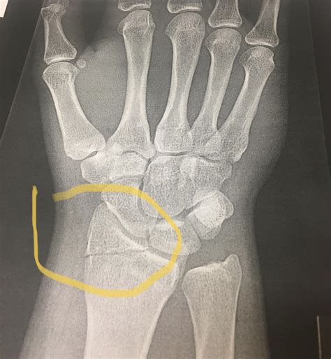 How serious is a intra-articular distal radius fracture? It’s my right ...