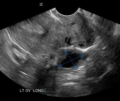 Pelvic Ultrasound Ovarian Cysts