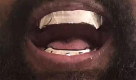 Kanye West's Unique $850,000 Titanium Dentures Are 'Permanent' And 'Go ...