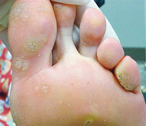 Warts on Feet - Pictures, Treatment, Causes, Contagious