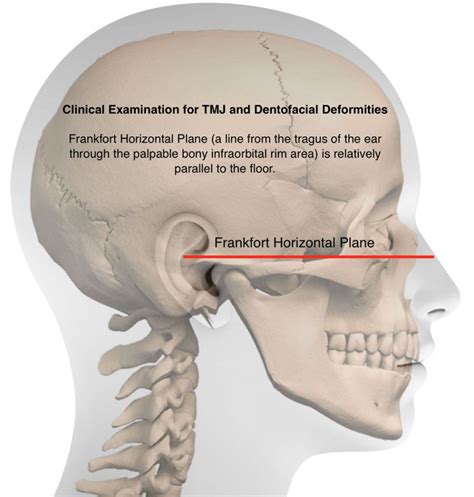 Lips should be parallel to the 'Frankfort Horizontal Plane' Stem Girls, Jaw Surgery, Myofascial ...