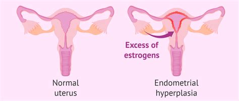 What is endometrial hyperplasia?