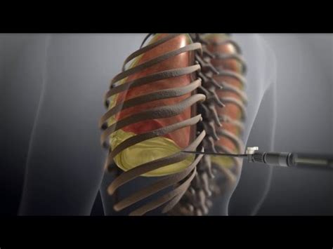 Thoracentesis: What is it for, Procedure, Complications - science - 2024