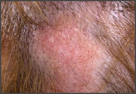 Pictures of shingles on the scalp | Shingles Expert