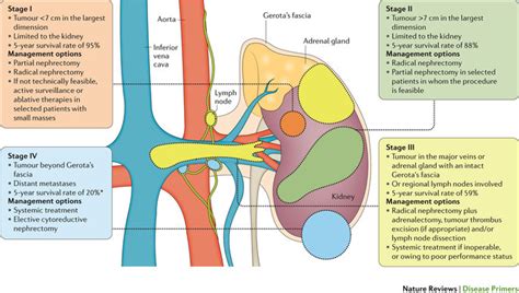 Renal/ Kidney cancer | notes.nursium.com