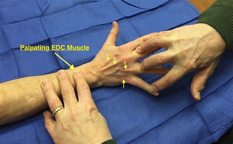 Muscle Test and Tendon Exam: Extensor Digitorum Communis (EDC) | Hand Surgery Resource