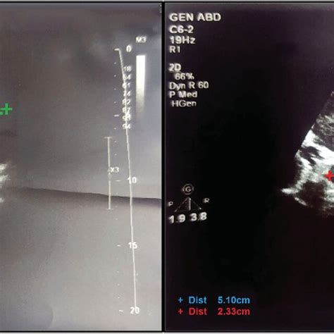 Color Doppler ultrasound of the left kidney. (A) Renal vein thrombosis ...