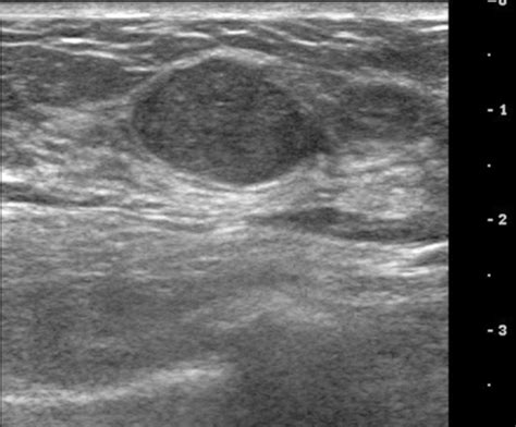 Ultrasound image of left breast taken 2 years after ori | Open-i