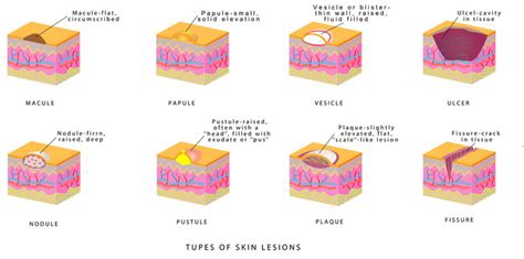 Macule Vs Papule