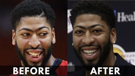 Anthony Davis Teeth Transformation [Updated]: Before & After