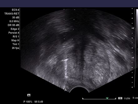 Transrectal ultrasound–guided prostate biopsy | Radiology Reference ...