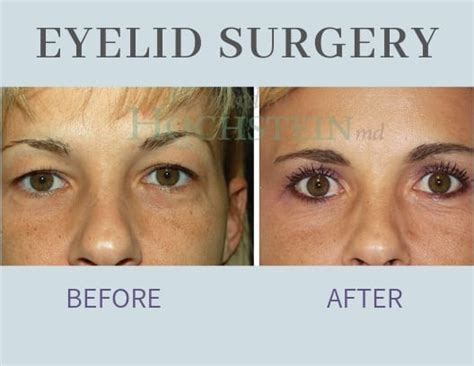 Asymmetrical Face Surgery Before And After