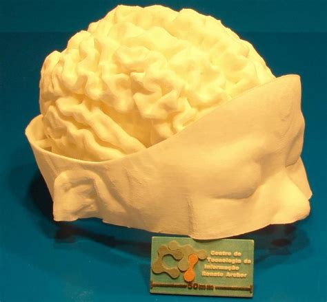 3D Printing Aids in the Complex Brain Surgery of a Baby in Brazil | 3DPrint.com | The Voice of ...