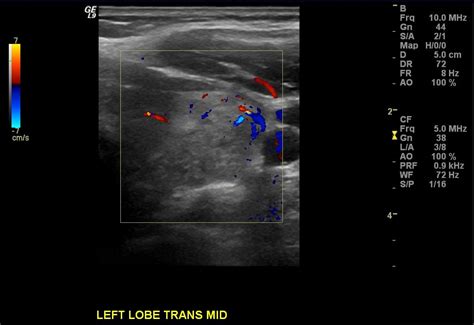 Thyroid Ultrasound