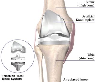 Minimally Invasive Knee Joint Replacement - Northeast Orthopedics Sports Clinic & Physical Therapy