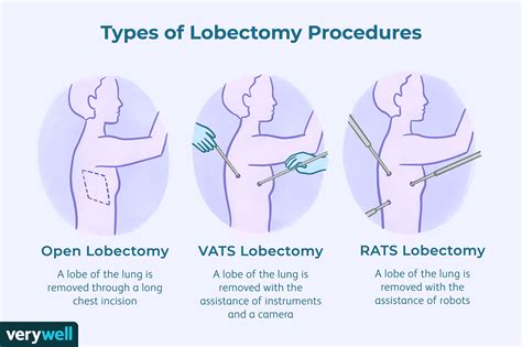 Recovery After a Lobectomy for Lung Cancer