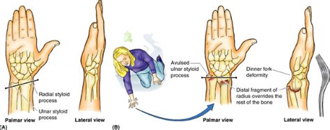 DINNER FORK DEFORMITY - Mobile Physiotherapy Clinic Ahmedabad Gujarat