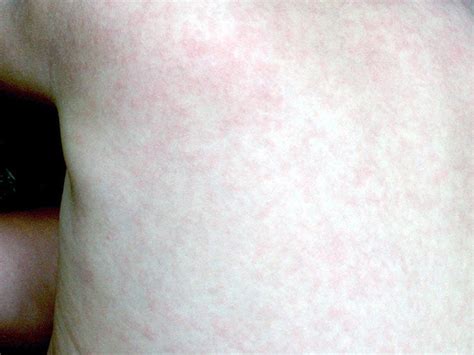 Roseola rash: symptoms, pictures, and treatment - Medical News Today