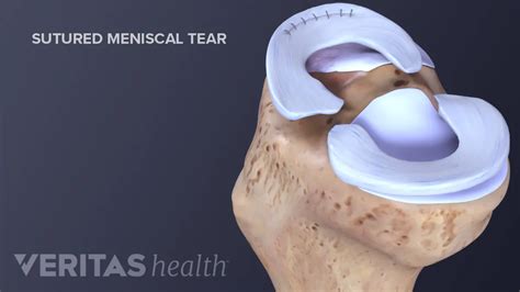 Meniscus Problems Torn Meniscus Repair Animation | lupon.gov.ph