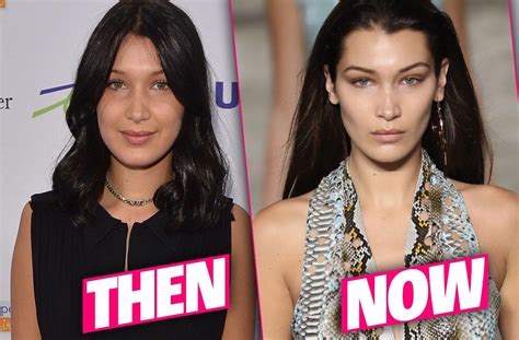 Bella Hadid Plastic Surgery Makeover Exposed By Top Doctors