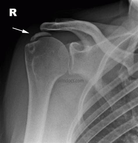 Calcific Tendonitis | Arm Docs