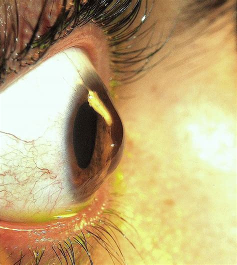 Keratoconus - Causes, Symptoms, Contact Lenses, Surgery, Treatment