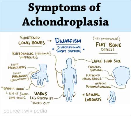 Achondroplasia – causes, symptoms, treatment – Healthy Food Near Me