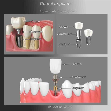 How much does it cost to put a crown over a dental implant - Dental News Network