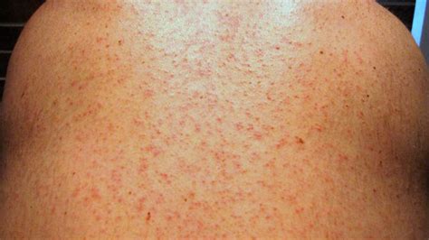 Maculopapular Rash: Causes, Treatment, and More