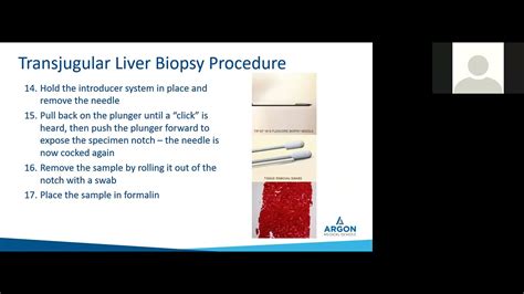 Transjugular Liver Biopsy Procedure and Argon Medical's TLAB Tricks & Tips - YouTube