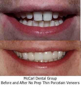 Getting Porcelain Veneers: The Step-by-Step Process - McCarl Dental Group