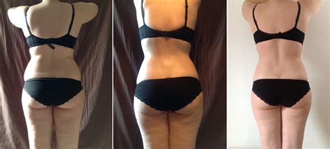 Vaser Lipo Before & After Pics 2 ½ Months On | I Am Fabulicious