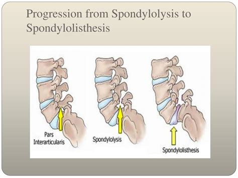 PPT - Physiotherapy of Spondylolysis PowerPoint Presentation, free download - ID:672840