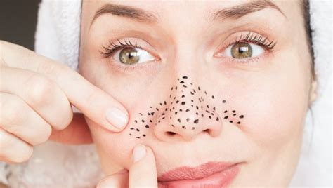 8 dermatologist-approved home remedies for blackheads | HealthShots