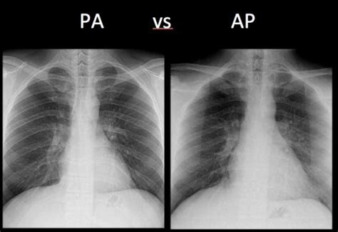 Chest X-Ray Basics: PA vs. AP - radRounds Radiology Network