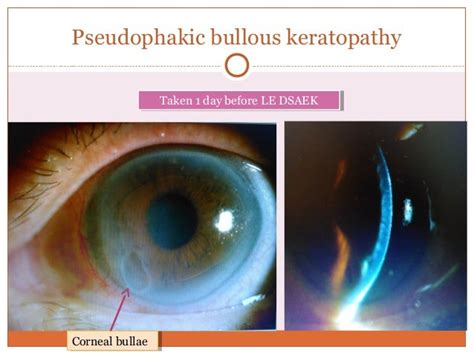 Pseudophakic Bullous Keratopathy case