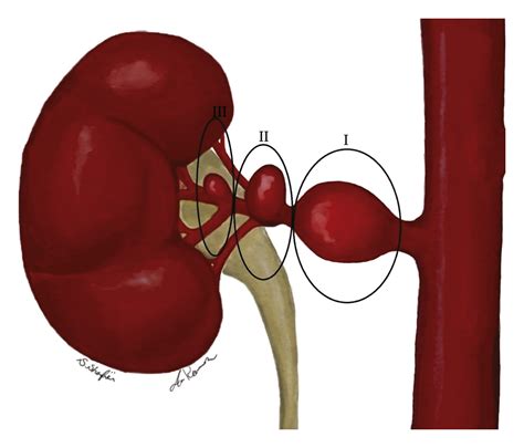 Renal Artery Repair with Kidney Autotransplantation for Renal Artery Aneurysms - European ...