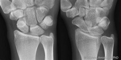 Roentgen Ray Reader: De Quervain Tenosynovitis: Radiographic Findings