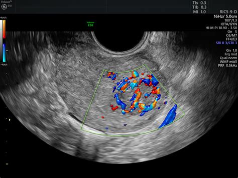 Ultrasound Fibroids | Empowered Women's Health