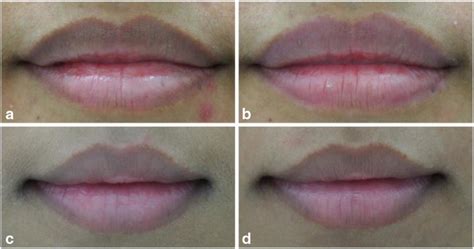 How To Remove Hyperpigmentation From Lips | Lipstutorial.org