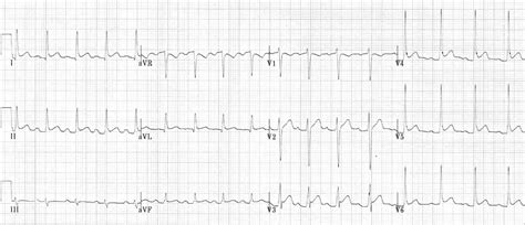 Acute Pericarditis Ecg Changes