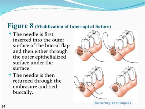 Suture presentation by Dr. Nabeel ur Rehman and Dr. Suneel Maghnani