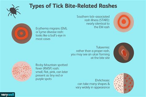 Lyme Disease Tick Bite Rash