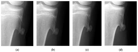 JCM | Free Full-Text | Treatment Strategy of Fractured Osteochondroma in the Young Athlete’s Knee