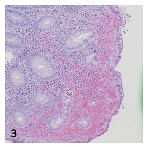 Histological features. (a, b) Distortion of the crypt architecture ...