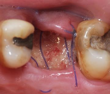 Bone Graft Pain - Dental News Network