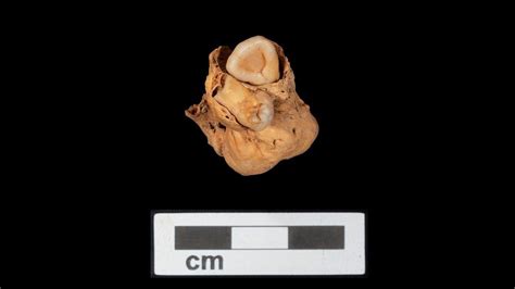 A rare teratoma (tumor with teeth) has been discovered in an Egyptian burial from 3,000 years ...