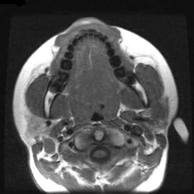 Malignant Parotid Tumor Imaging: Practice Essentials, Radiography ...